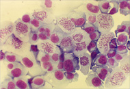 Cellules d'hépato-carcinome inhibées par une chimiothérapie